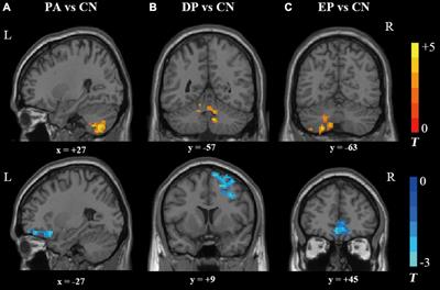 Lateralized brain activities in subcortical vascular mild cognitive impairment with differential Chinese medicine patterns: A resting-state functional magnetic resonance imaging study